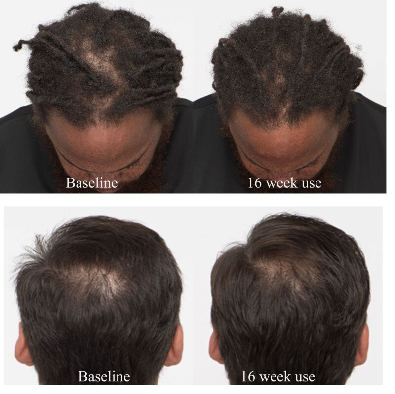 Methylsulfonylmethane and Hair Health Natural Medicine Journal